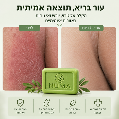 סבון טיפולי נגד פטריות