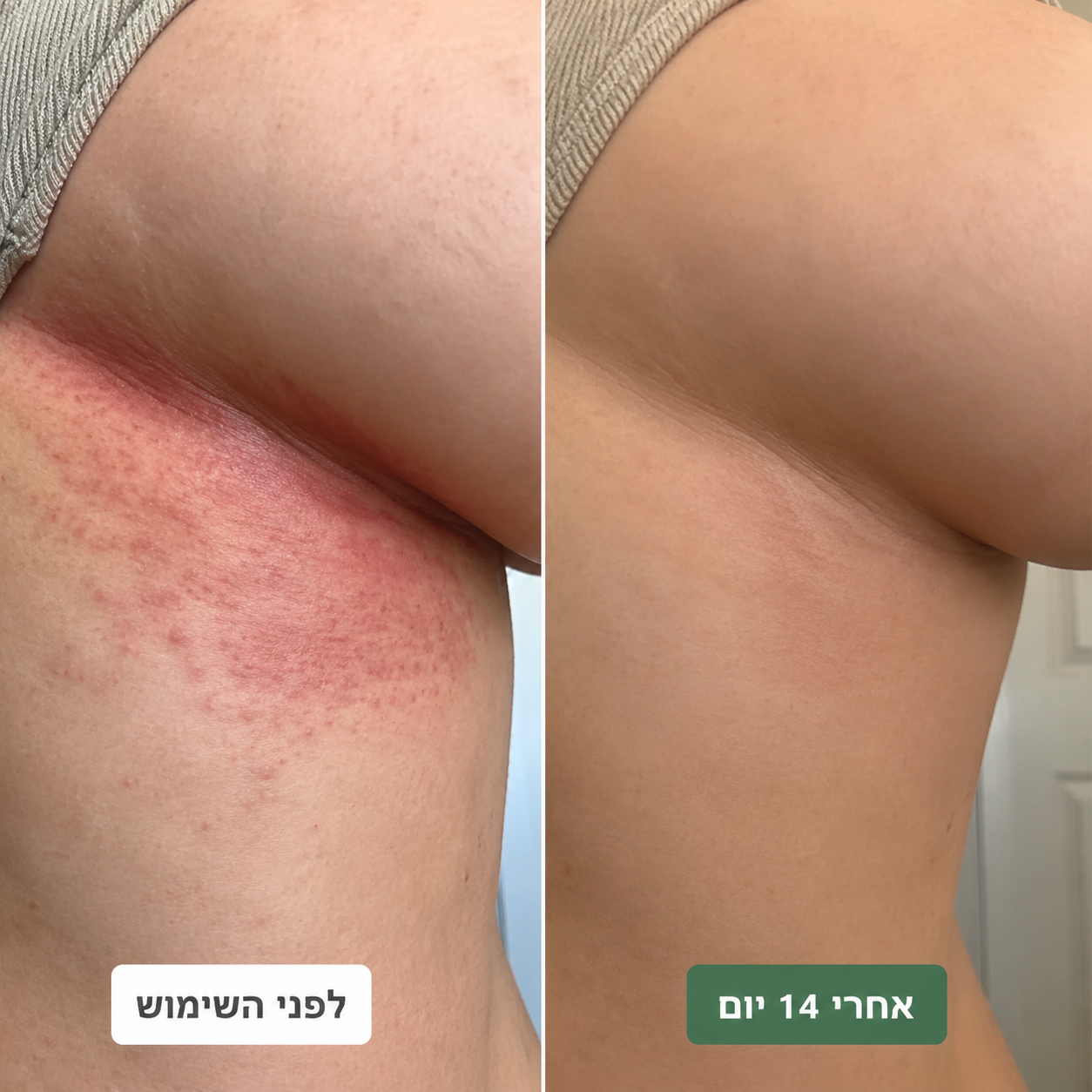 סבון טיפולי נגד פטריות לאישה