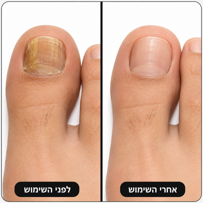 עט מריחה לטיפול בפטרת הציפורניים