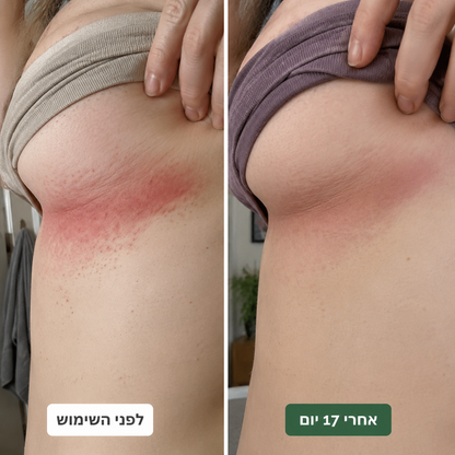 סבון טיפולי נגד פטריות לאישה